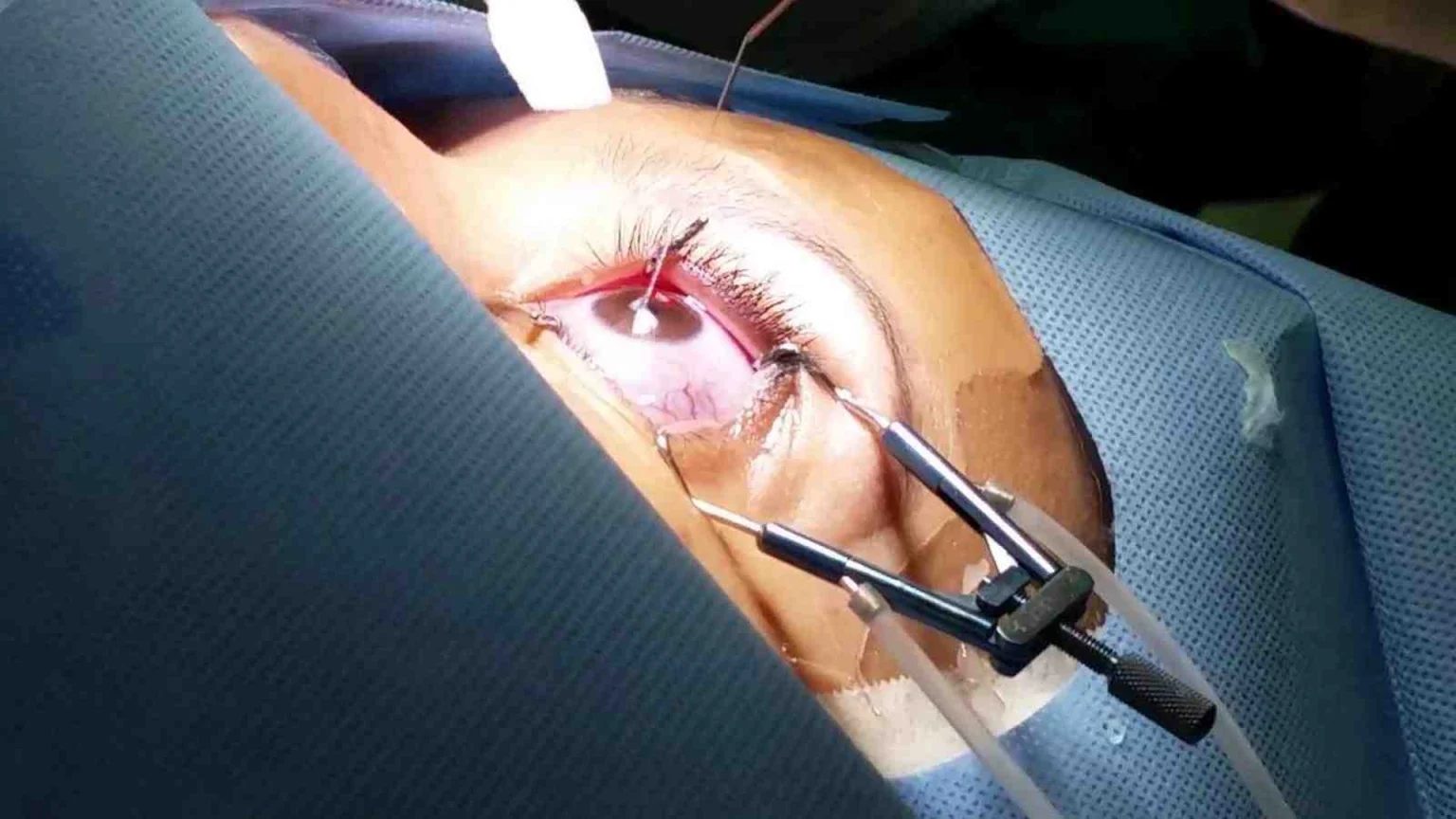 Olho durante cirurgia refrativa a laser